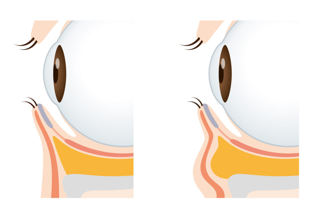 2-3. 突出した「眼窩脂肪(がんかしぼう)」の押し出し