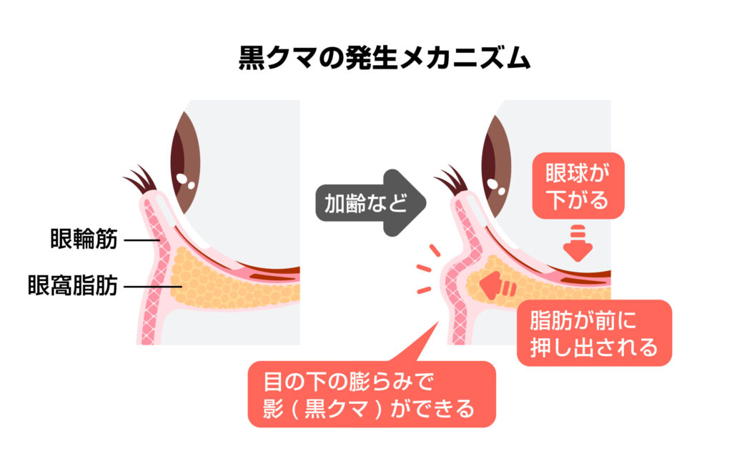 1-3. 眼窩脂肪の突出が引き起こす3つの見た目の問題