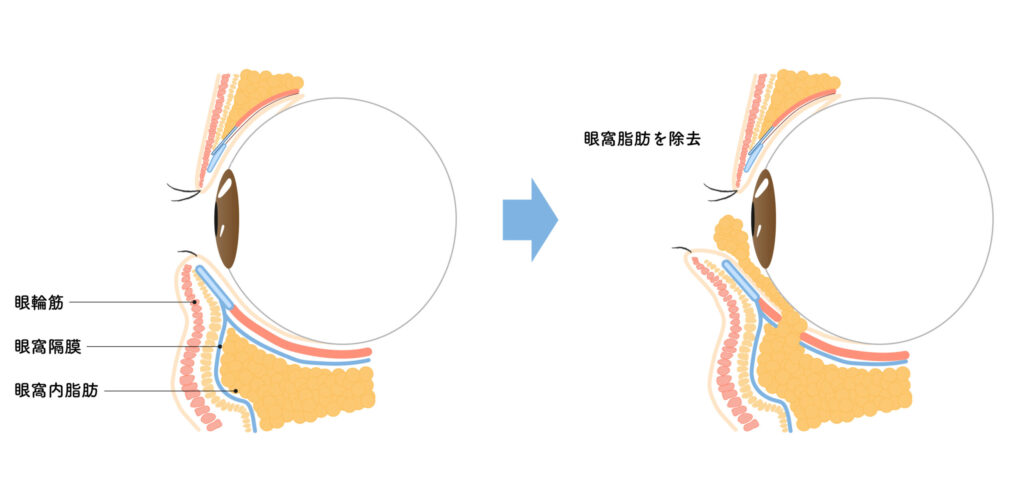 1-1. 眼窩脂肪とは何か——眼球を守るクッション組織