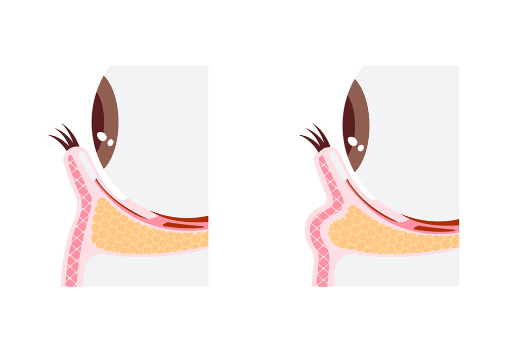 第4章 【黒クマ】マッサージが逆効果になるリスクと正しいアプローチ