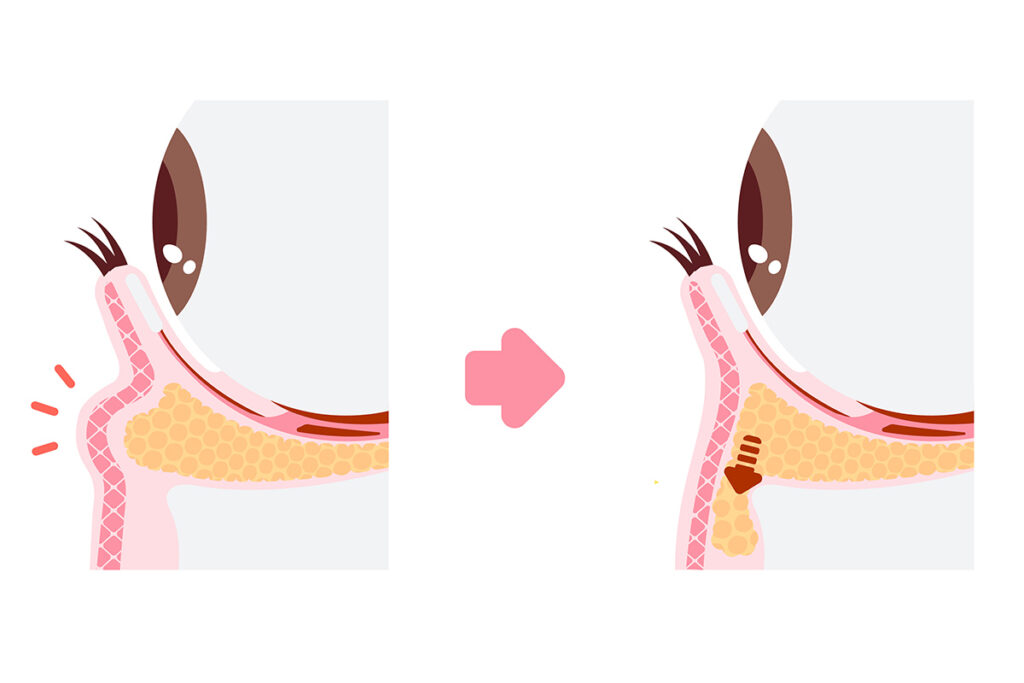 4章. 改善しない生まれつきのクマに効果のある美容医療