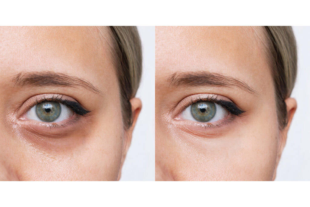 4-2. 生まれつきの青クマ・茶クマを改善できる治療法