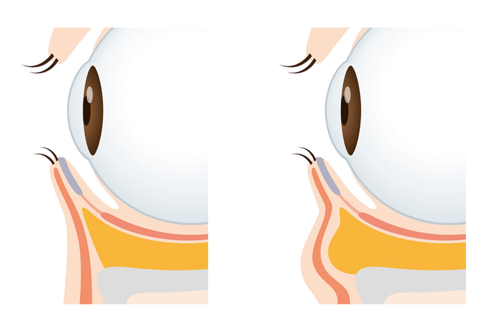 第1章 クマ取り後の腫れはいつまで？ピークとダウンタイムについて