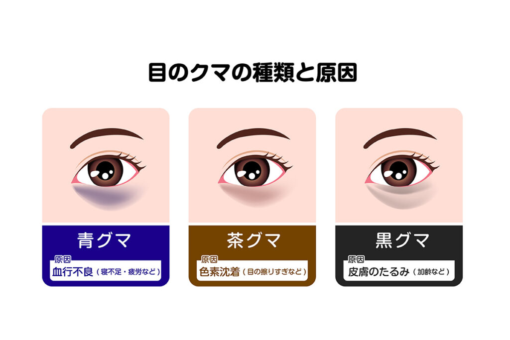 第1章 自分のクマの種類を見分ける診断方法と茶クマの原因とは？