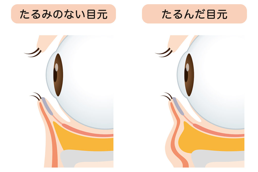 1-1. アイクリームで「消えるクマ」と「消えないクマ」の違い