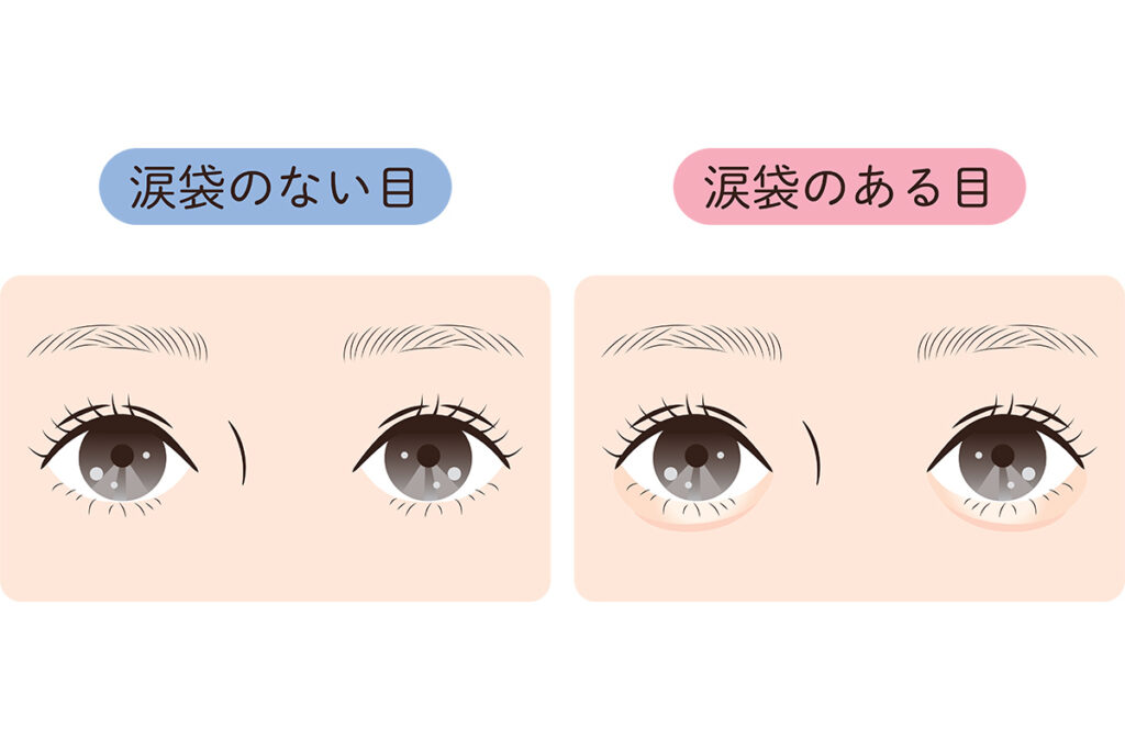 第1章 涙袋とクマ・たるみの違いとは?