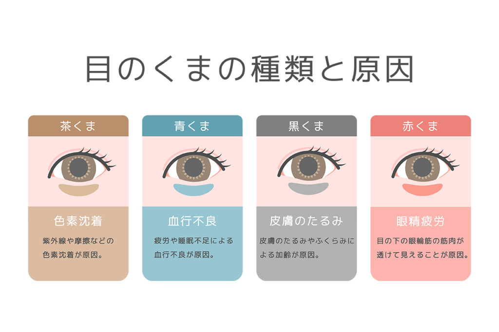 1-2. クマの正体は「影・色素・血行不良・筋肉の透け」の4タイプ