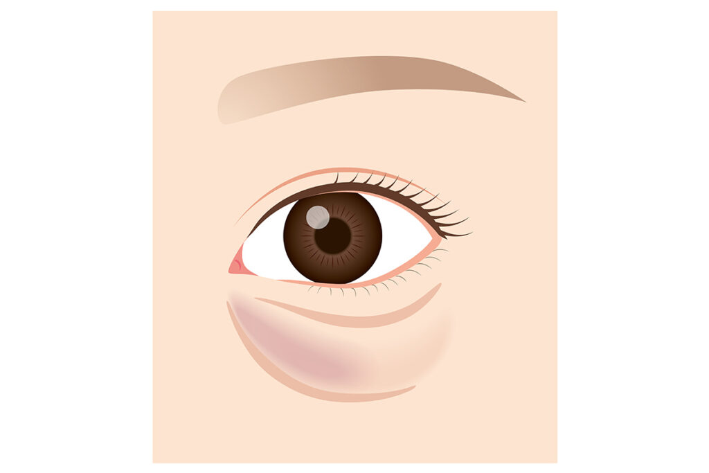 第1章 クマ取りで後悔しないためにリスクと失敗を知ろう