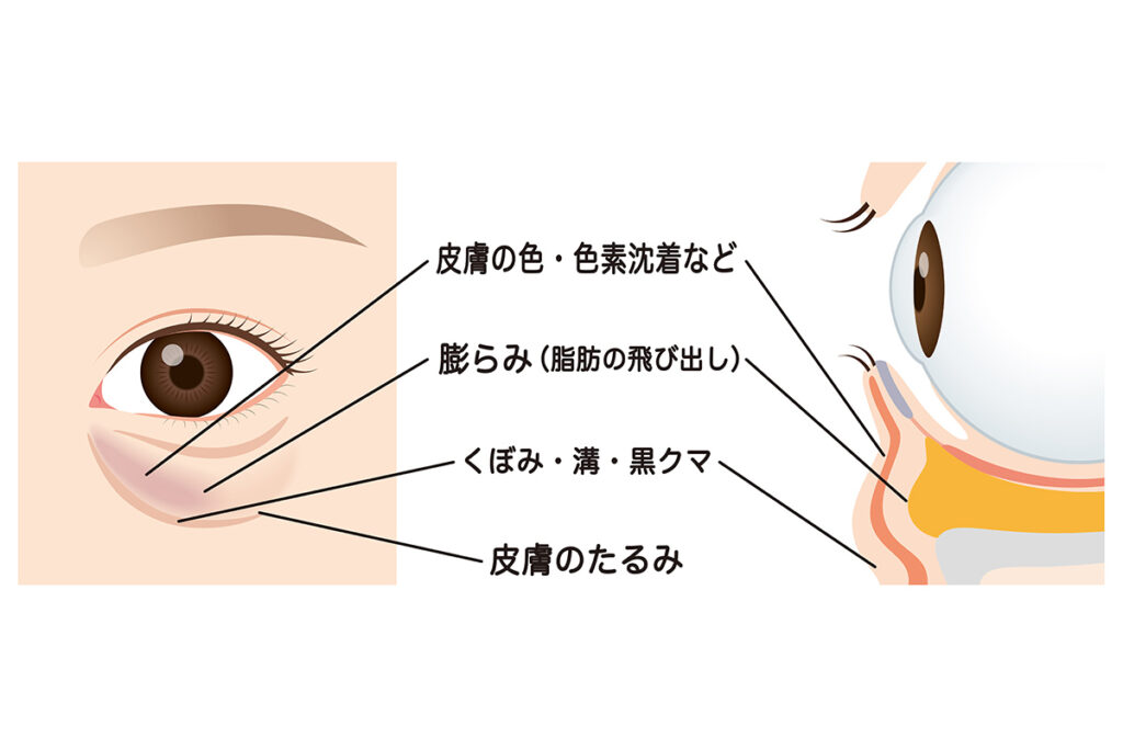 第1章. 目の下のヒアルロン酸注入とは？クマへの効果とメリット
