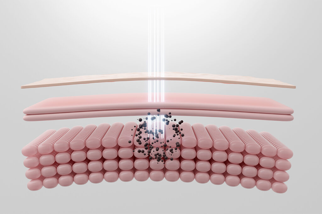 第2章 茶クマ治療に効くレーザーの種類と効果を徹底比較