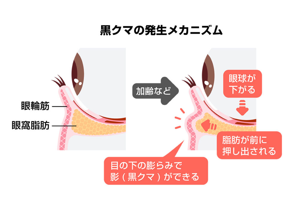 2-1. 黒クマ(影クマ)・たるみの場合