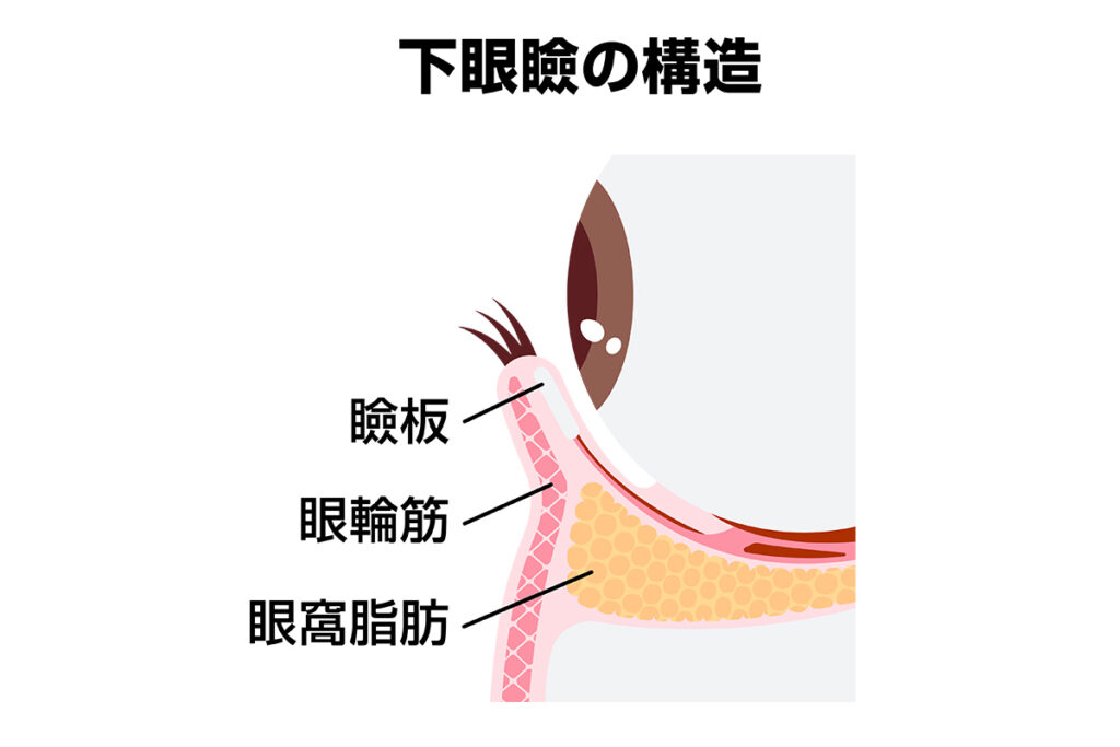 3-2. 下眼瞼外反（あっかんべー状態）と涙小管損傷