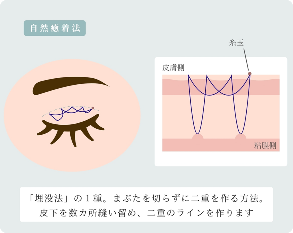 埋没法に分類される「自然癒着法」という選択も