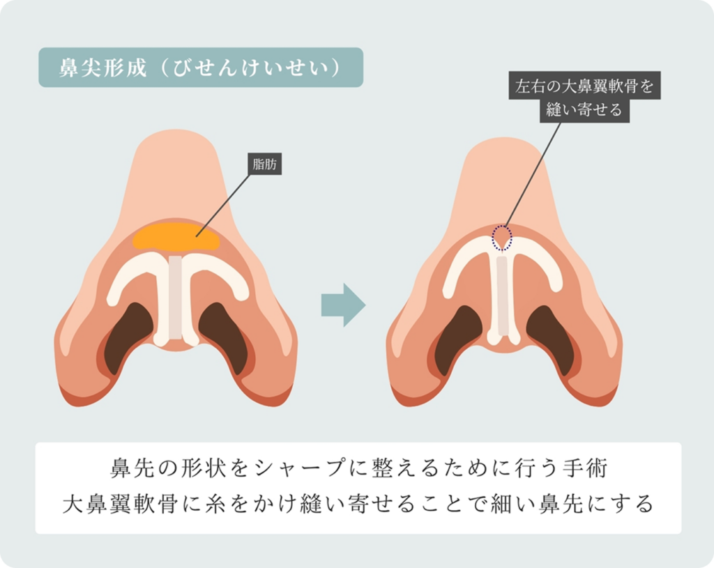 自家軟骨(耳介軟骨など)