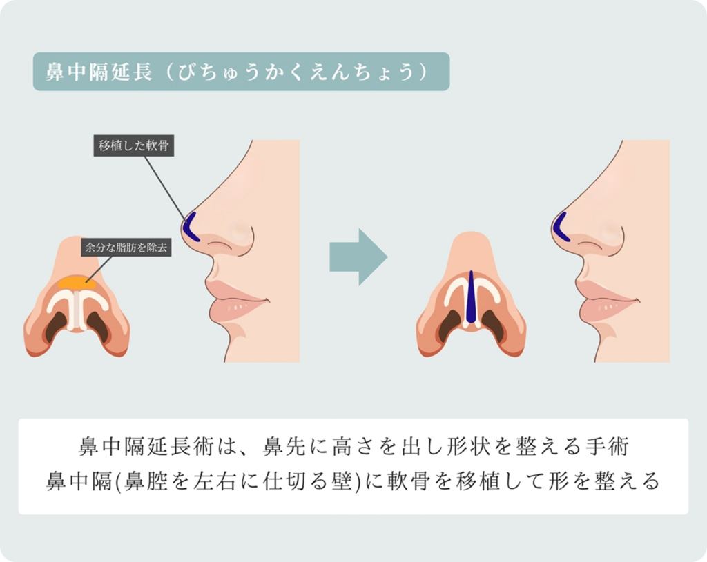 鼻中隔延長