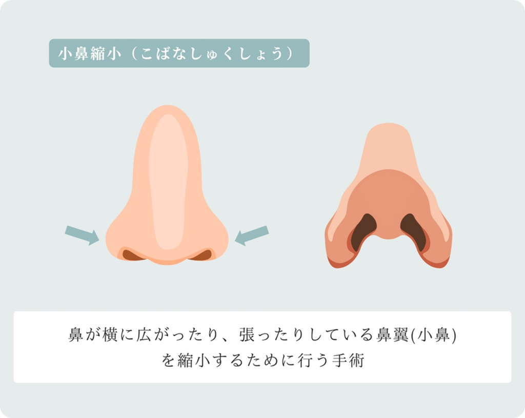 小鼻縮小